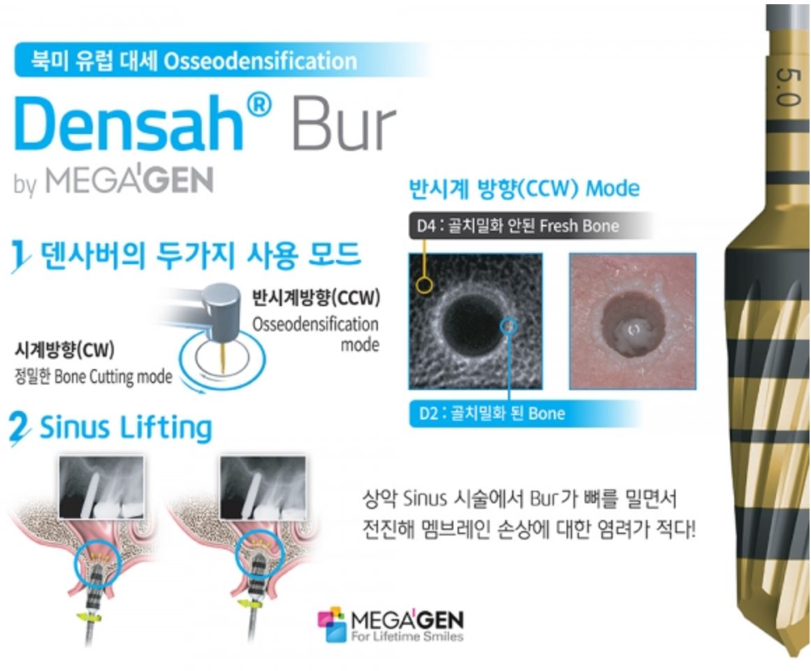 덴사버(Densah Bur) 기구 사진