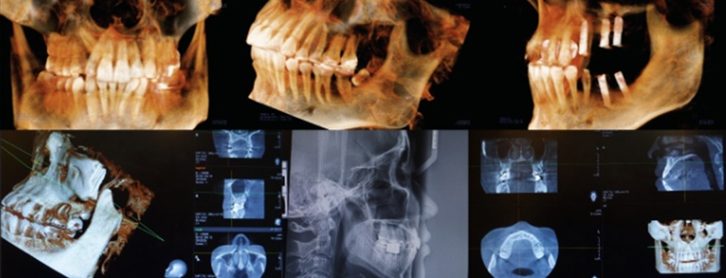 임플란트 재수술 진단을 위한 CBCT 단면 영상